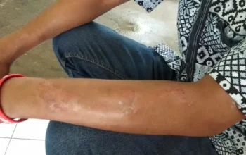 Kasus Kusta di Indonesia Tertinggi Ketiga di Dunia, Prof Tjandra Yoga Soroti 3 Hal Penting