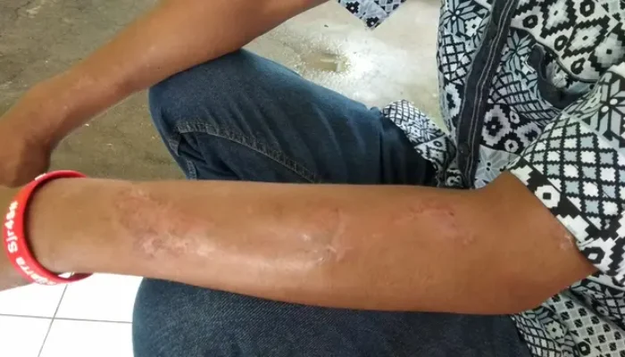 Kasus Kusta di Indonesia Tertinggi Ketiga di Dunia, Prof Tjandra Yoga Soroti 3 Hal Penting