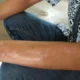 Kasus Kusta di Indonesia Tertinggi Ketiga di Dunia, Prof Tjandra Yoga Soroti 3 Hal Penting
