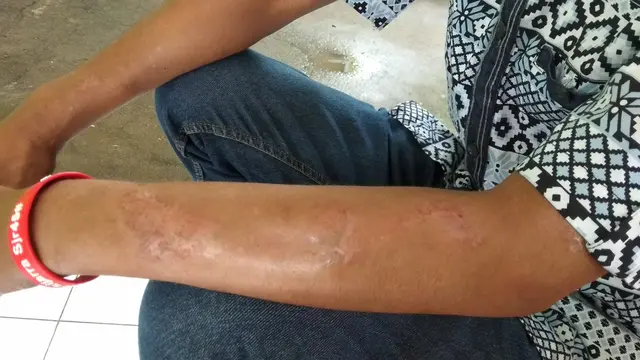 Kasus Kusta di Indonesia Tertinggi Ketiga di Dunia, Prof Tjandra Yoga Soroti 3 Hal Penting